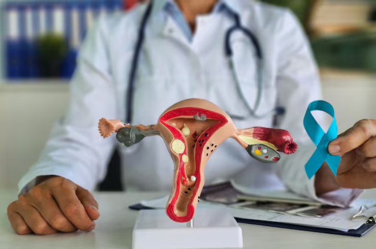 Uterine Cancer